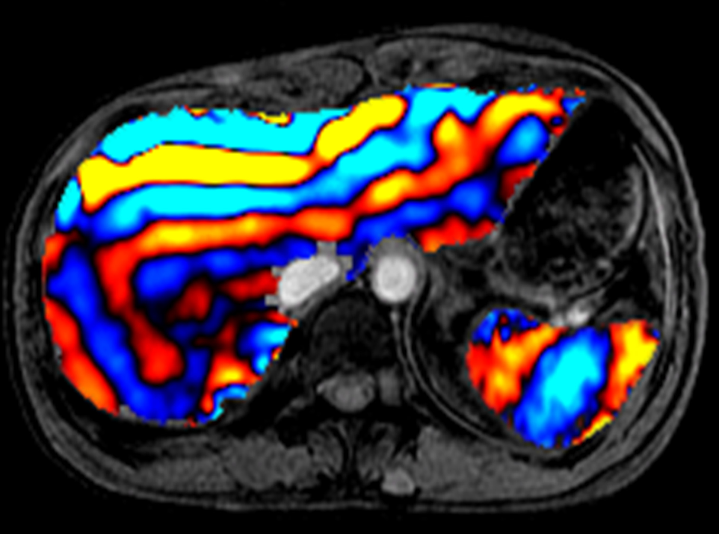 New Ultrasound Technique Developed For Diagnosing And Tracking Liver ...